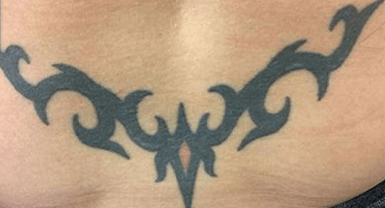 Laser-Tattoo-Removal-Oneonta-Before