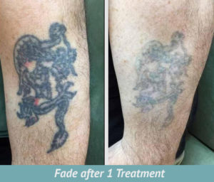 Color tattoo removal