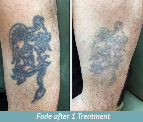 How To Fade A Tattoo | Laser Tattoo Removal Oneonta | New York Skin & Vein  Tattoo Removal