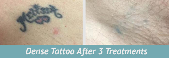 tattoo removal6
