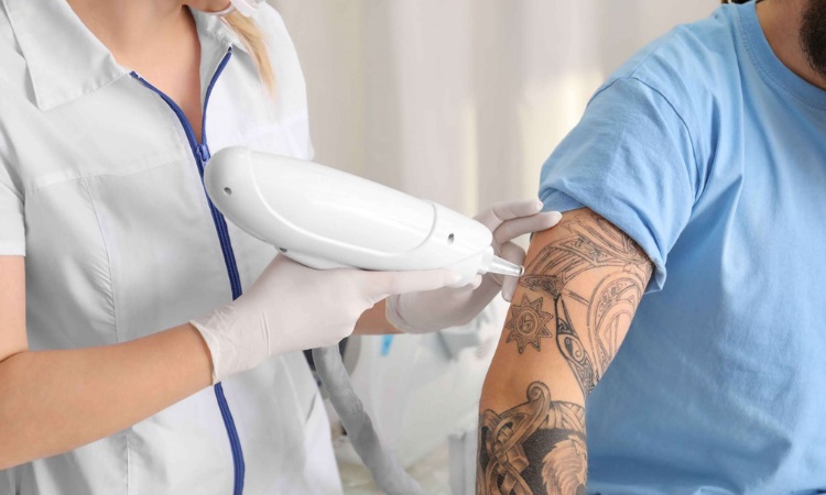 Laser Tattoo Removal Oneonta
