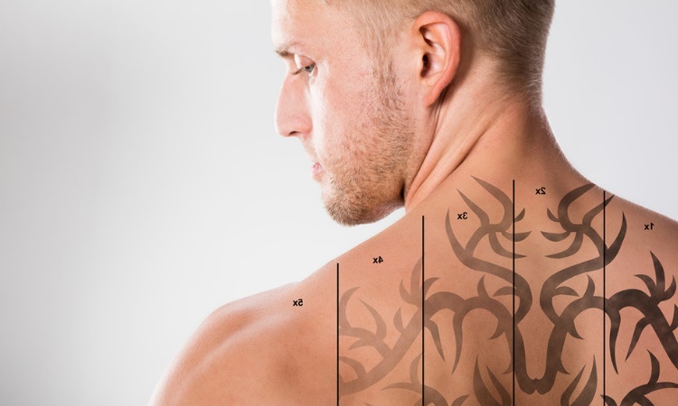 Laser Tattoo Removal Oneonta